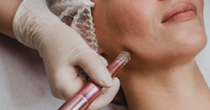 Microneedling: qué es y para qué sirve